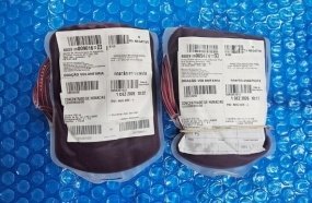 SC recebe bolsas de sangue raro para tratar criança com anemia falciforme