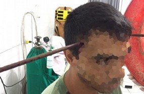 Neurocirurgião remove ferro da cabeça de jovem de Tangará