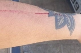 Jovem é assaltada e ferida por dupla em Capinzal 