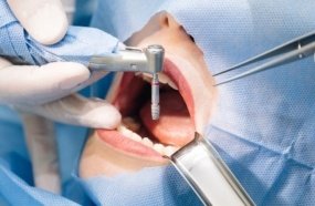 Dentista terá que indenizar e bancar novo tratamento após errar implante
