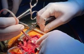 Santa Catarina realiza cirurgia de traqueia inédita em bebê de três meses 