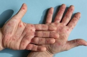 Saúde confirma primeiro caso de nova cepa de mpox no Brasil 