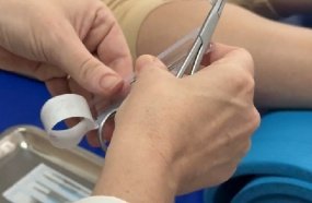 Joaçaba leva tratamento de acupuntura para os bairros Santa Helena e Nova Petrópolis